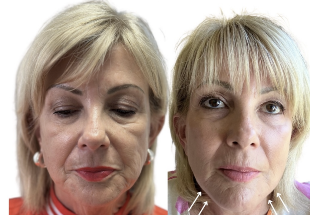 neck pdo threads boca raton